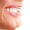 Invisalign 4 image